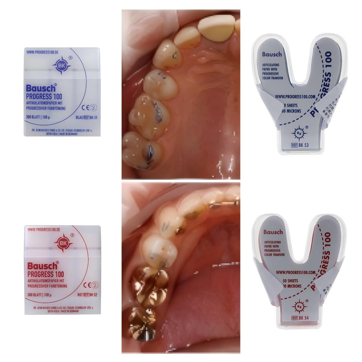 Bausch BK51 BK52 BK53 BK54 Den - Bite Indicator reseña y precio
